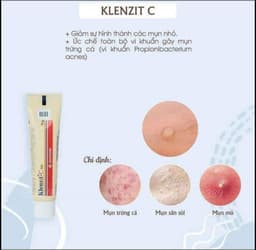 CHẤM MỤN KLENZIT C MỤN VIÊM , MỤN BỌC, MỤN NẶNG