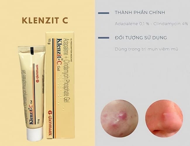CHẤM MỤN KLENZIT C MỤN VIÊM , MỤN BỌC, MỤN NẶNG