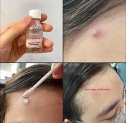 CHẤM MỤN NEOGEN