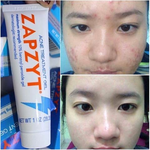 CHẤM MỤN ZAPZYT