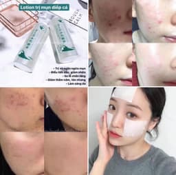 TONER TRỊ MỤN RAU DIẾP CÁ DOKUDAMI