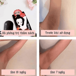 XÀ PHÒNG TRỊ THÂM NÁCH